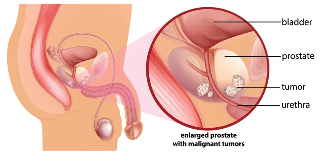 Prostate Cancer