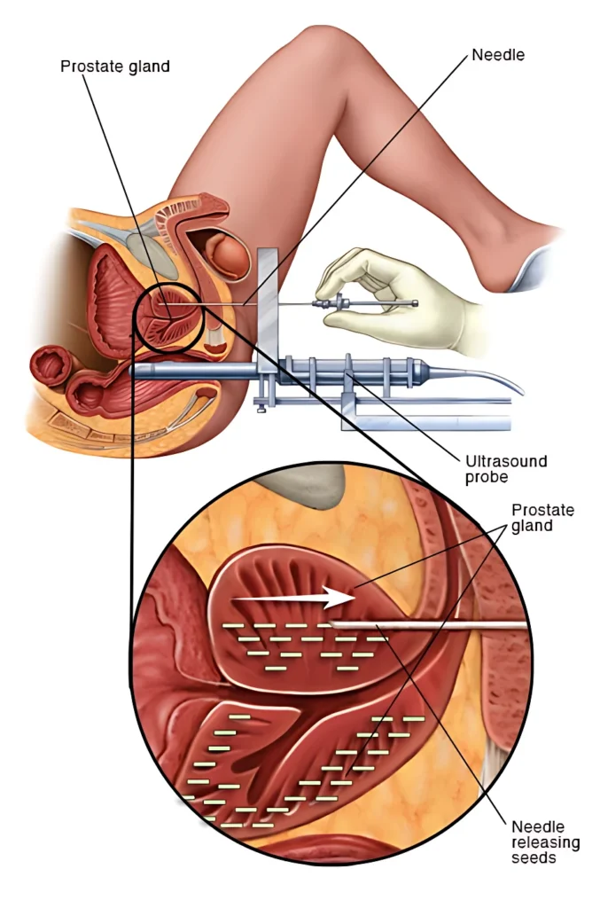 Prostate Cancer Symptoms