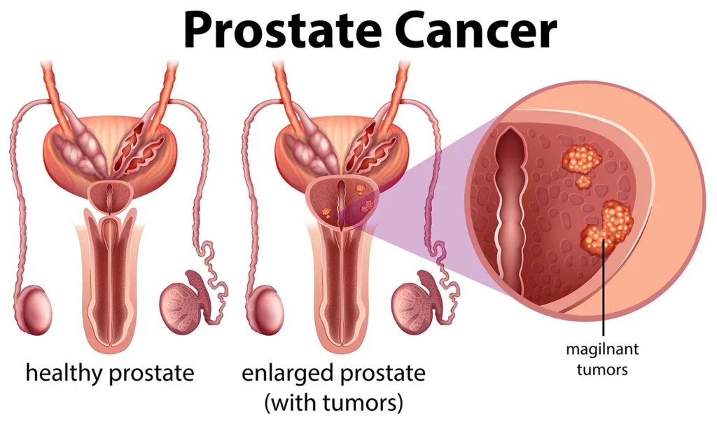 Prostate Cancer Treatment for Elderly Men