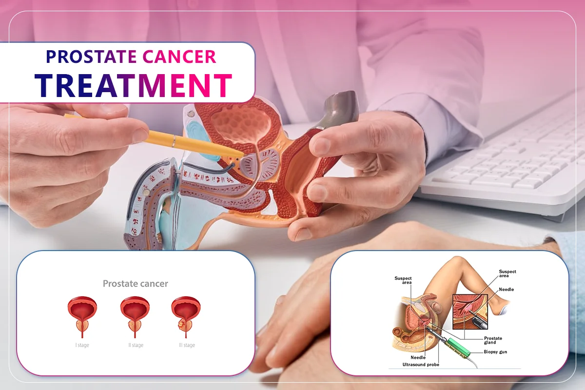 Prostate Cancer Treatment
