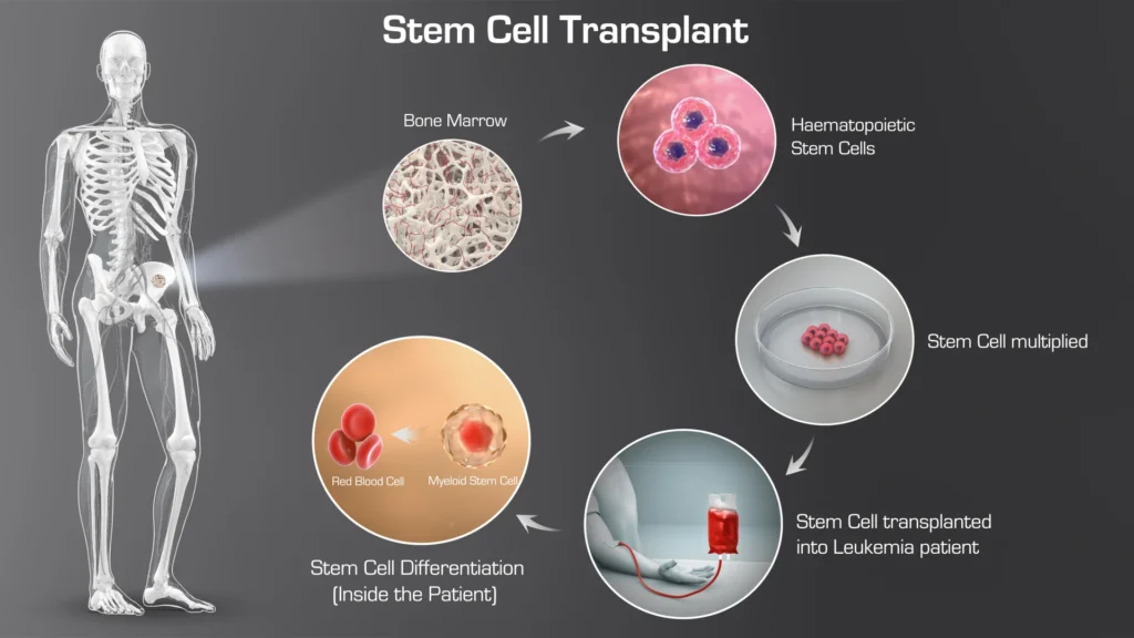 Stem Cell (Bone Marrow) Transplant Process