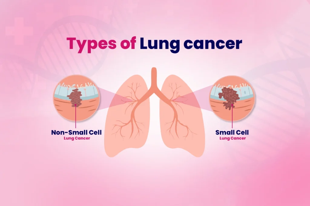 types-of-lung-cancer-and-treatments-Thaimedics