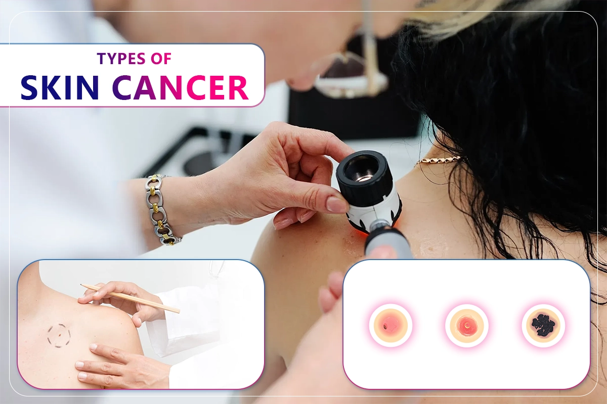 types-of-skin-cancer-Thaimedics