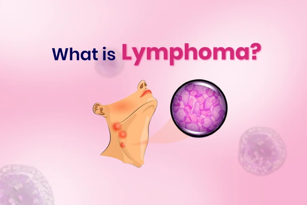 treatment-for-lymphoma-Thaimedics