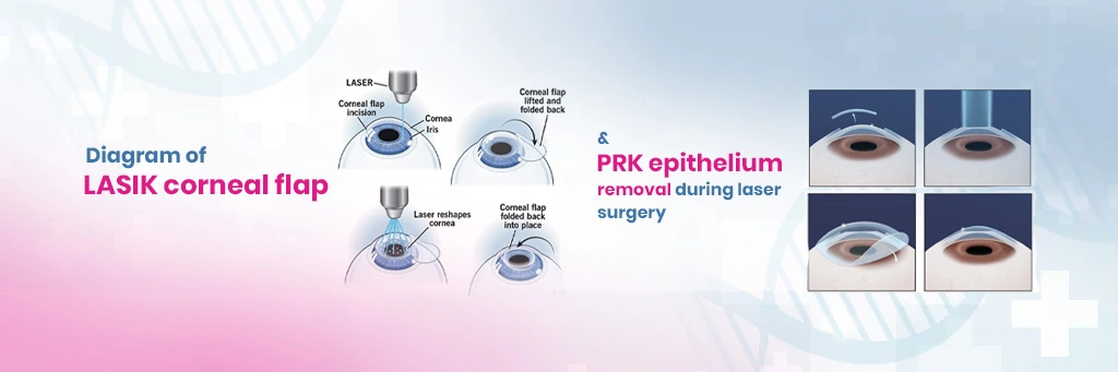 LASIK vs. PRK: Which Eye Surgery Is Right for You? 2 LASIK vs. PRK: The Main Differences